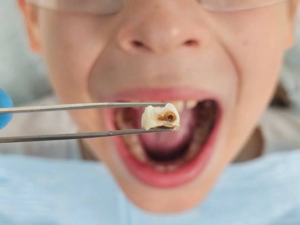 Best Emergency Wisdom Tooth Extraction in Pine Ridge, FL
